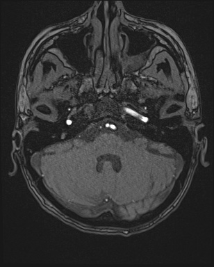 Cerebral embolic infarcts (embolic shower) (Radiopaedia 72391-82921 Axial MRA 18).jpg