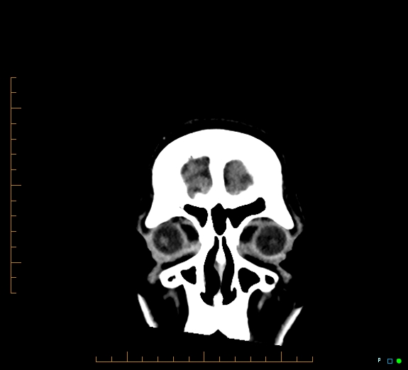 Cerebral fat embolism (Radiopaedia 85521-101220 Coronal non-contrast 8).jpg