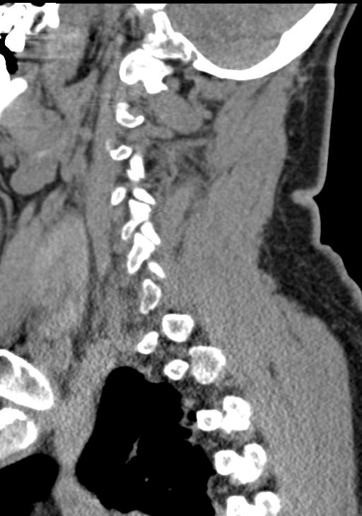 Cerebral hemorrhagic contusions and cervical spine fractures (Radiopaedia 32865-33841 G 77).jpg