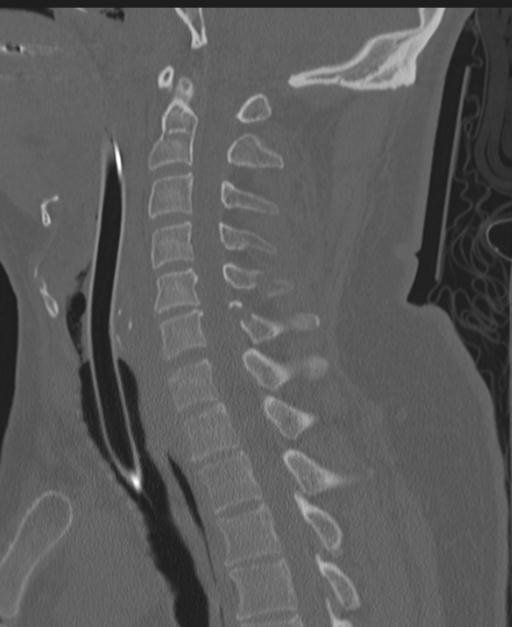 Cerebral hemorrhagic contusions and cervical spine fractures (Radiopaedia 32865-33841 Sagittal bone window 49).jpg