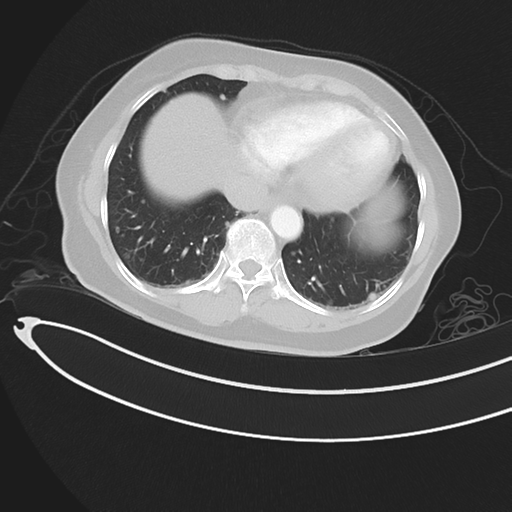 Cerebral metastases (Radiopaedia 33041-34055 Axial lung window 42).png