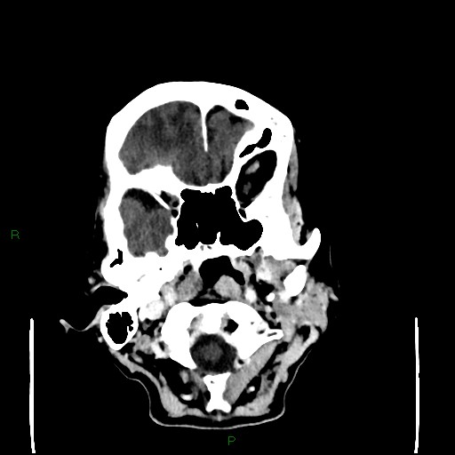 Cerebral metastases - breast primary (Radiopaedia 77653-89857 Axial C+ delayed 19).jpg