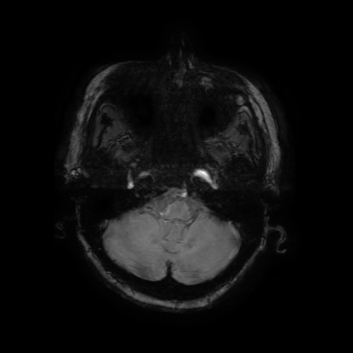 Cerebral metastases - melanoma (Radiopaedia 80972-94522 Axial SWI 20).jpg