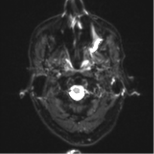 Cerebral metastasis - melanoma (Radiopaedia 54718-60954 Axial DWI 2).png
