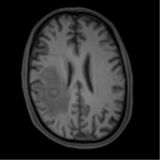 Cerebral metastasis - melanoma (Radiopaedia 54718-60954 Axial T1 34).png