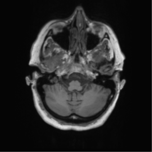 Cerebral metastasis mimicking glioblastoma (Radiopaedia 69155-78937 Axial T1 8).png