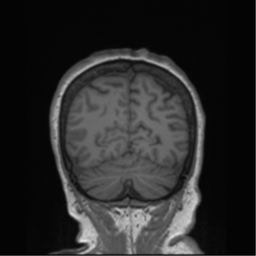 Cerebral metastasis to basal ganglia (Radiopaedia 81568-95413 Coronal T1 1).png