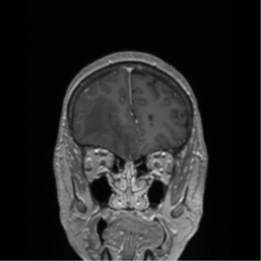 File:Cerebral metastasis to basal ganglia (Radiopaedia 81568-95413 Coronal T1 C+ 50).png