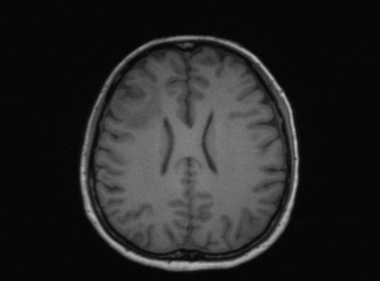 Cerebral ring enhancing lesions - cerebral metastases (Radiopaedia 44922-48817 Axial T1 190).jpg