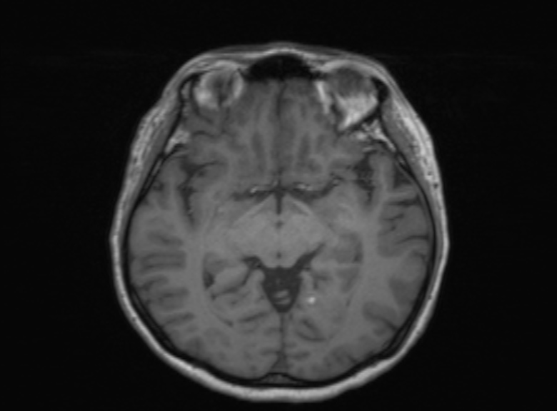 Cerebral ring enhancing lesions - cerebral metastases (Radiopaedia 44922-48817 Axial T1 246).jpg