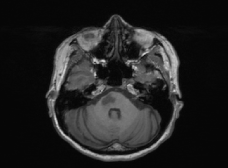 Cerebral ring enhancing lesions - cerebral metastases (Radiopaedia 44922-48817 Axial T1 298).jpg