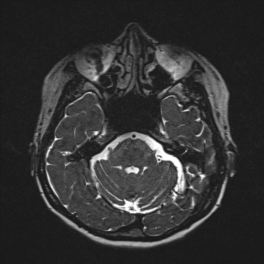 Cerebral ring enhancing lesions - cerebral metastases (Radiopaedia 44922-48817 F 45).jpg
