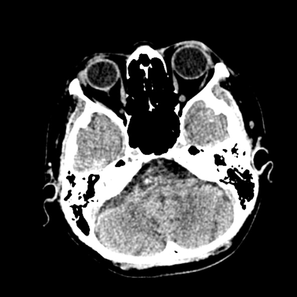 Cerebral ring enhancing lesions - cerebral metastases (Radiopaedia 44922-48818 Axial non-contrast 17).jpg