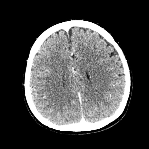 File:Cerebral ring enhancing lesions - cerebral metastases (Radiopaedia 44922-48818 B 187).jpg