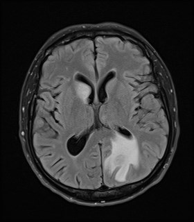 File:Cerebral toxoplasmosis (Radiopaedia 43956-47461 Axial FLAIR 12).jpg
