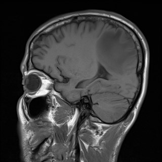 File:Cerebral toxoplasmosis (Radiopaedia 43956-47461 Sagittal T1 15).jpg