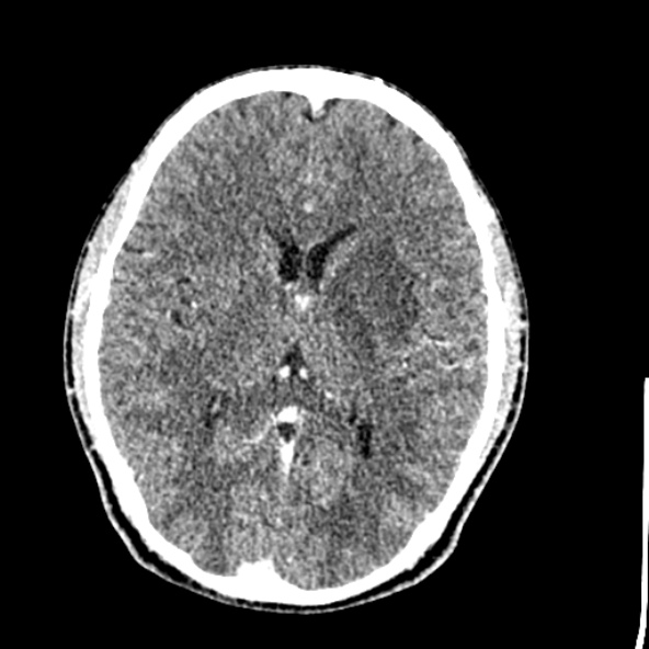 Cerebral toxoplasmosis (Radiopaedia 53993-60131 Axial C+ delayed 39).jpg