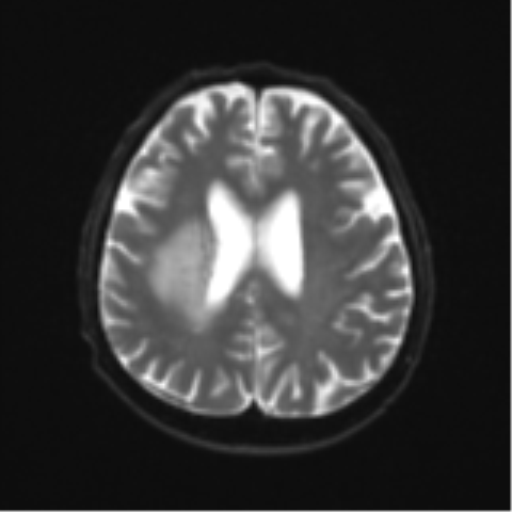 Cerebral toxoplasmosis (Radiopaedia 54575-60804 Axial DWI 22).png