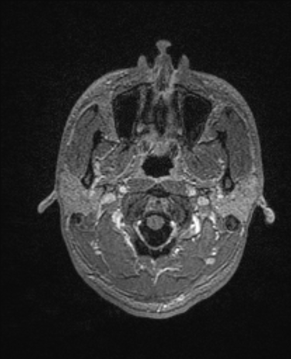 Cerebral toxoplasmosis (Radiopaedia 85779-101597 Axial T1 C+ 11).jpg