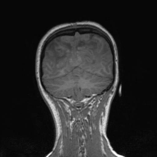 Cerebral tuberculosis with dural sinus invasion (Radiopaedia 60353-68090 Coronal T1 145).jpg