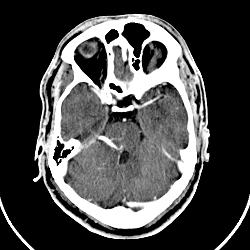 File:Cerebral venous angioma (Radiopaedia 69959-79977 B 20).jpg