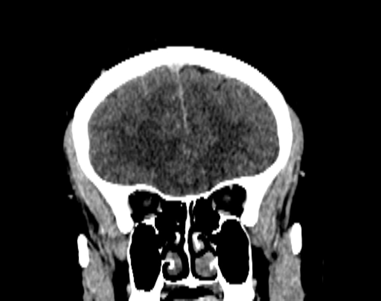 File:Cerebral venous hemorrhagic infarct from venous sinus thrombosis (Radiopaedia 55433-61883 Coronal C+ delayed 21).jpg