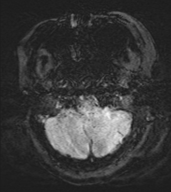 Cerebral venous infarct (Radiopaedia 53627-59685 Axial SWI 6).jpg