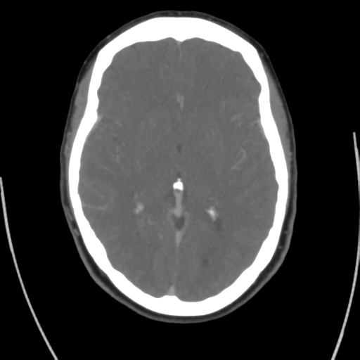 Cerebral venous infarct related to dural venous sinus thromboses (Radiopaedia 35292-36804 Axial C+ delayed 25).png