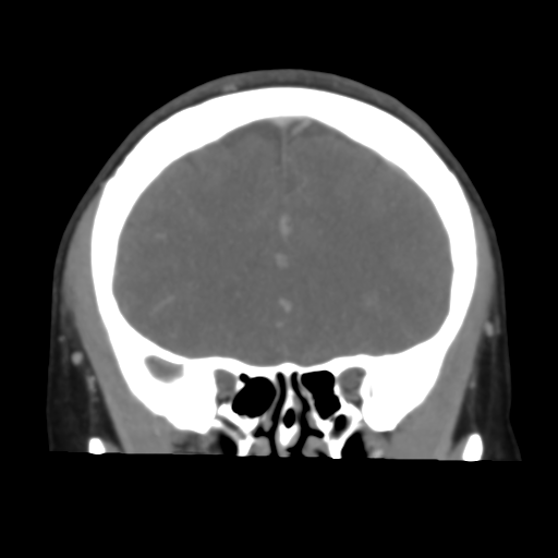 File:Cerebral venous infarction due to transverse sinus thrombosis (Radiopaedia 34688-36120 Coronal 22).png