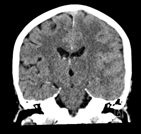 Cerebral venous infarction with hemorrhage (Radiopaedia 65343-74381 Coronal non-contrast 29).jpg