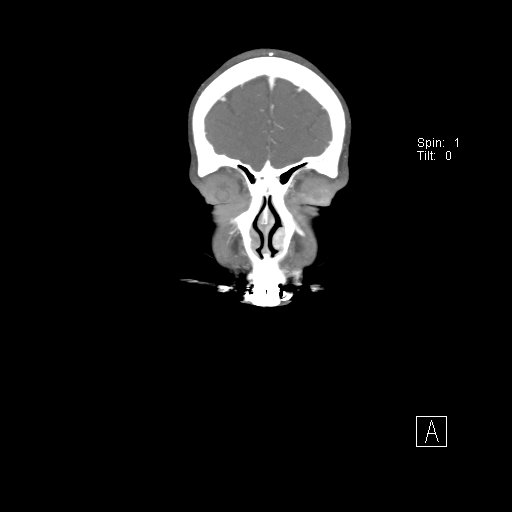 File:Cerebral venous infarction with hemorrhage (Radiopaedia 65343-74396 B 23).jpg