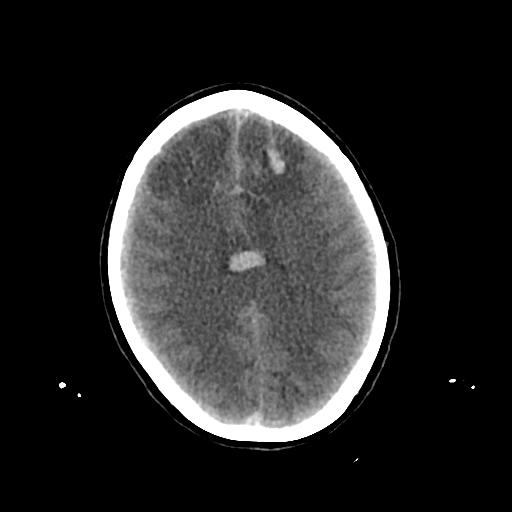 File:Cerebral venous throbmosis - hemorrhagic venous infarction (Radiopaedia 87318-103613 Axial non-contrast 111).jpg