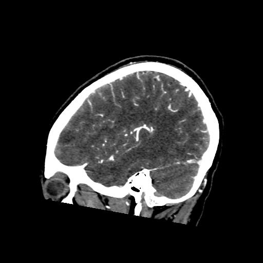 File:Cerebral venous throbmosis - hemorrhagic venous infarction (Radiopaedia 87318-103613 Sagittal CT venogram 36).jpg