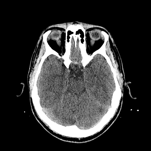 File:Cerebral venous thrombosis (CVT) (Radiopaedia 77524-89685 Axial non-contrast 17).jpg