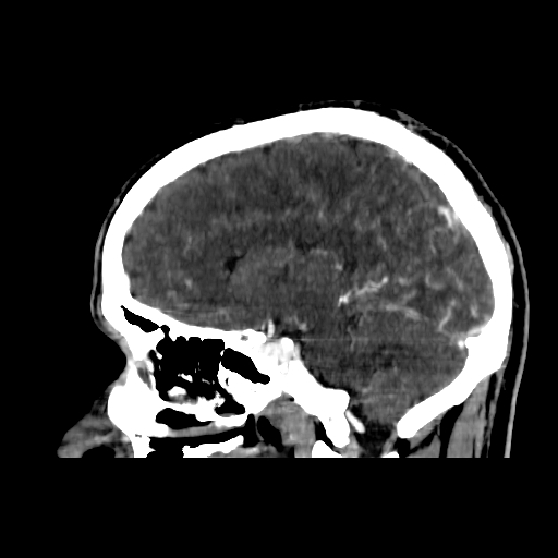 File:Cerebral venous thrombosis (CVT) (Radiopaedia 77524-89685 Sagittal CTV 26).jpg