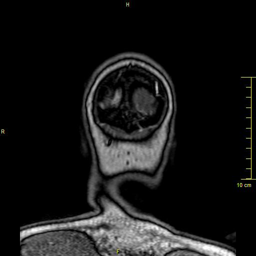 Cerebral venous thrombosis (Radiopaedia 23288-23351 MRV 177).JPG