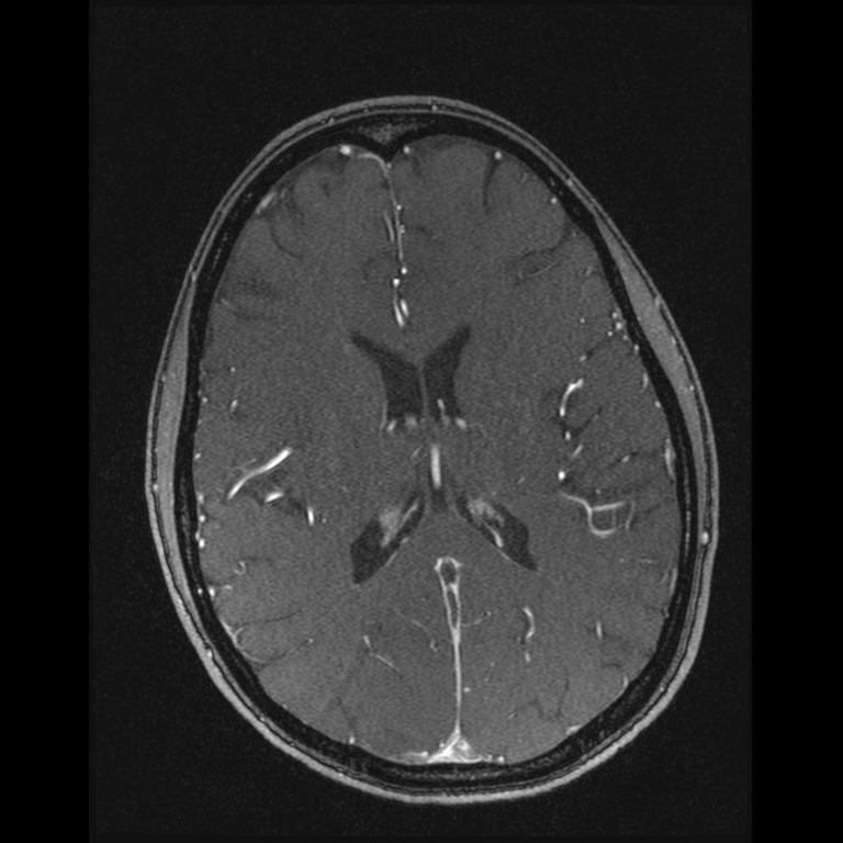 Cerebral venous thrombosis (Radiopaedia 45678-49854 Axial MRV 44).jpg