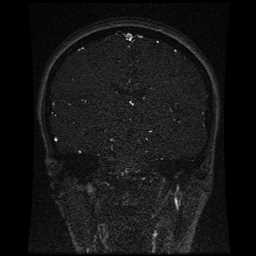 Cerebral venous thrombosis - ulcerative colitis (Radiopaedia 66049-75219 Coronal MRV 59).jpg