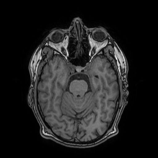 Cerebral venous thrombosis with secondary intracranial hypertension (Radiopaedia 89842-106957 Axial T1 70).jpg