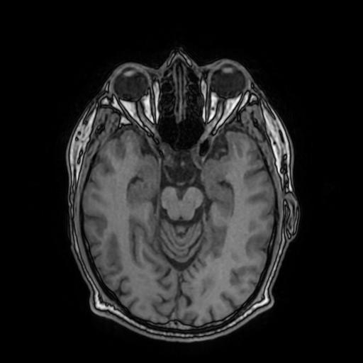 Cerebral venous thrombosis with secondary intracranial hypertension (Radiopaedia 89842-106957 Axial T1 77).jpg
