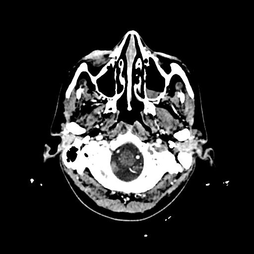File:Cerebral venous thrombosis with venous hemorrhagic infarct (Radiopaedia 90354-107660 Axial with contrast 20).jpg