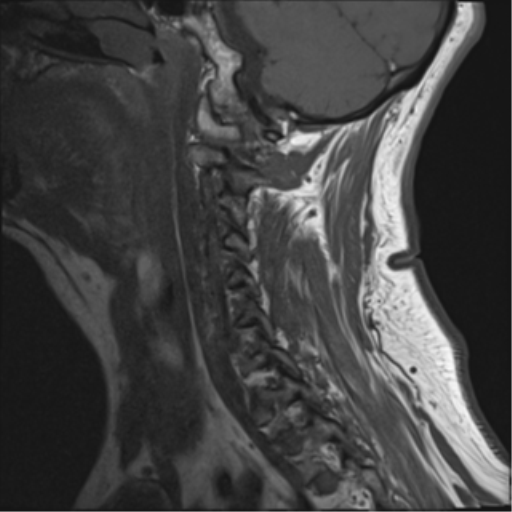 File:Cervical canal stenosis due to ossification of the posterior longitudinal ligament (Radiopaedia 47260-51824 Sagittal T1 3).png