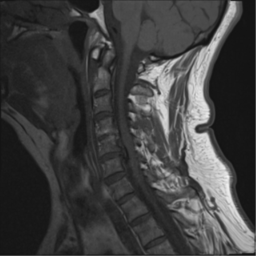 File:Cervical canal stenosis due to ossification of the posterior longitudinal ligament (Radiopaedia 47260-51824 Sagittal T1 6).png