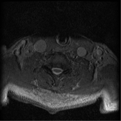 Cervical canal stenosis with cord compression (Radiopaedia 34114-35374 Axial Gradient Echo 25).png
