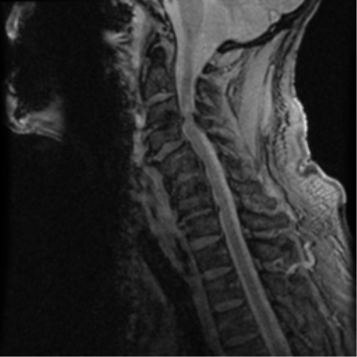 File:Cervical canal stenosis with cord compression (Radiopaedia 34114-35374 D 12).png