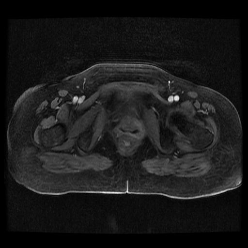 Cervical carcinoma (Radiopaedia 70924-81132 Axial T1 C+ fat sat 119).jpg