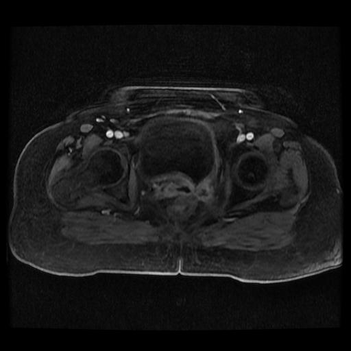 File:Cervical carcinoma (Radiopaedia 70924-81132 Axial T1 C+ fat sat 40).jpg