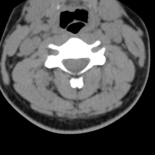 Cervical schwannoma (Radiopaedia 57979-64974 Axial non-contrast 30).png