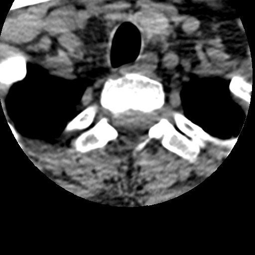 File:Cervical spinal neurofibroma in a patient with NF1 (Radiopaedia 58344-65464 Axial non-contrast 72).jpg