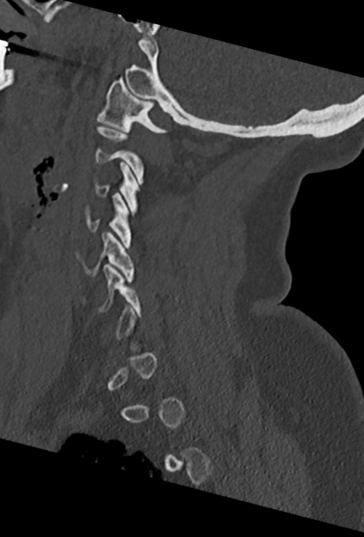 Cervical spine ACDF loosening (Radiopaedia 48998-54070 Sagittal bone window 30).png